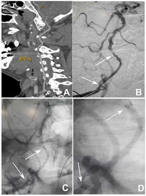 Case Report: Double Micro-Guidewire Technique for Emergent Rescue of Proximal Stent Collapse During Recanalization of Nonacute Occlusion of Vertebral Artery